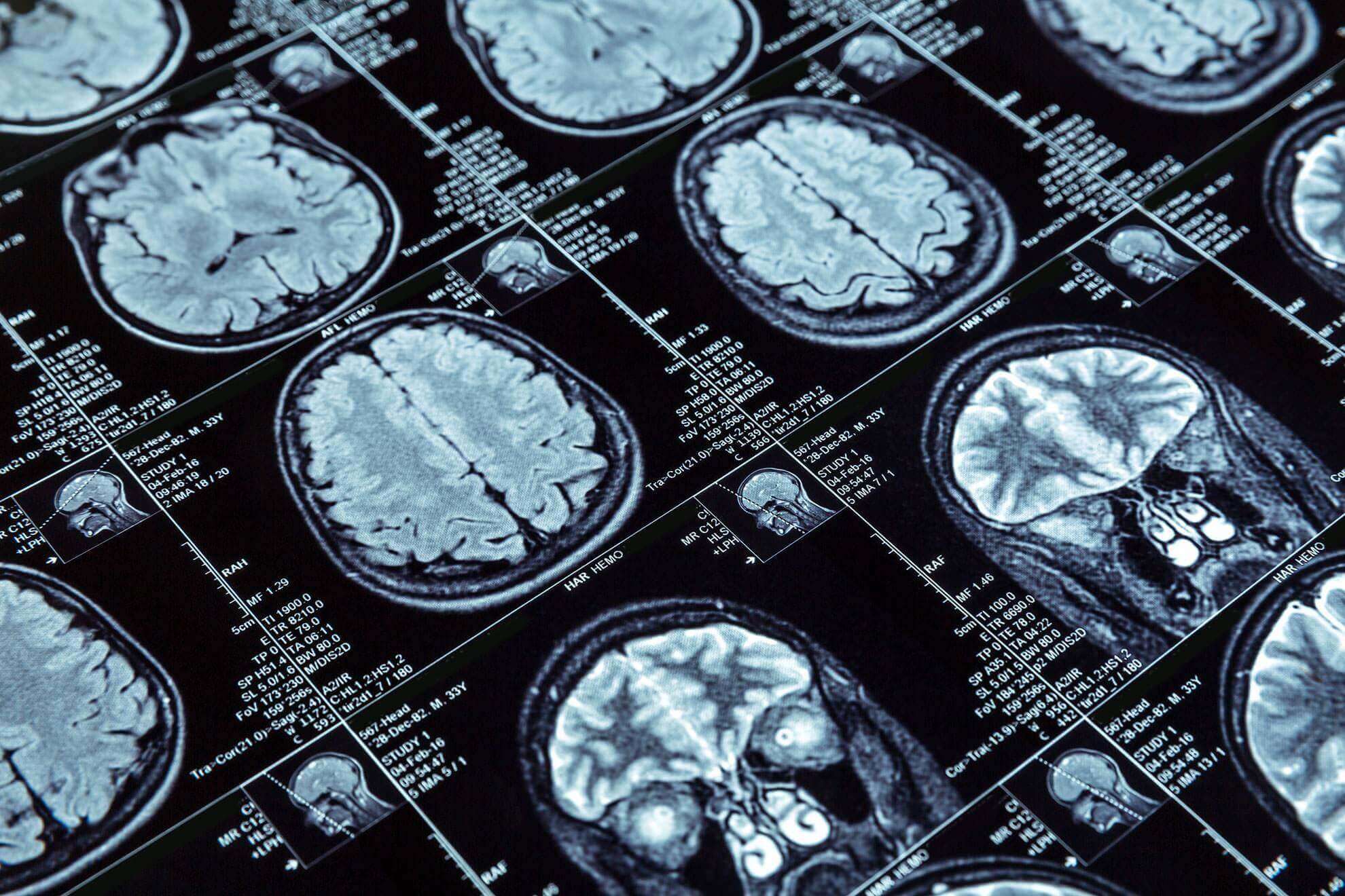 Brain Injury Lawyer in Toronto, Traumatic Brain Injury Attorney