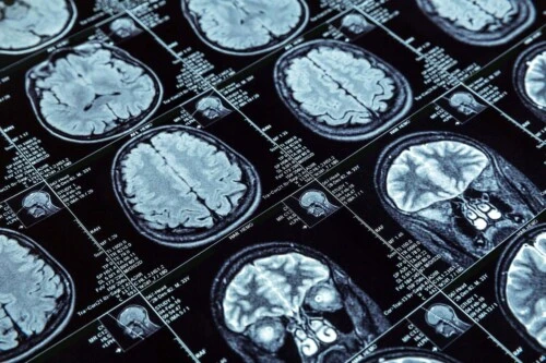 Brain Injury Scan and Claims in Toronto